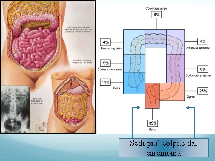 Sedi piu’ colpite dal carcinoma 