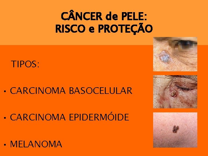 C NCER de PELE: RISCO e PROTEÇÃO TIPOS: • CARCINOMA BASOCELULAR • CARCINOMA EPIDERMÓIDE