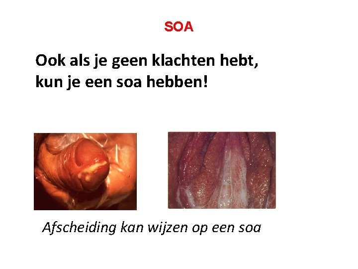 SOA Ook als je geen klachten hebt, kun je een soa hebben! Afscheiding kan