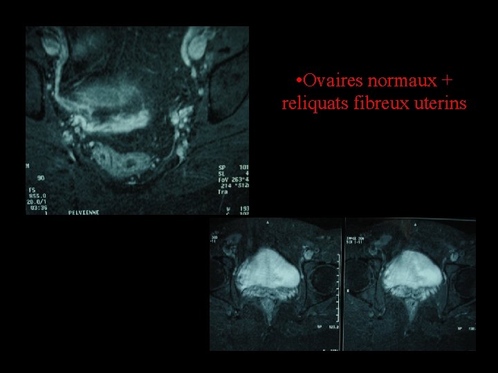  • Ovaires normaux + reliquats fibreux uterins 