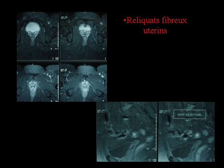  • Reliquats fibreux uterins 