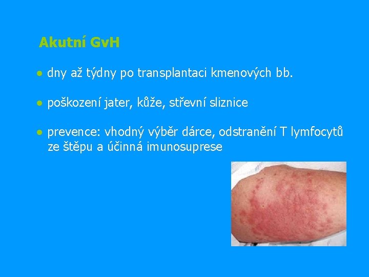 Akutní Gv. H ● dny až týdny po transplantaci kmenových bb. ● poškození jater,