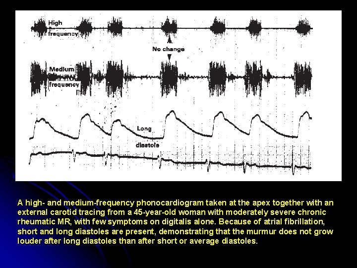 A high- and medium-frequency phonocardiogram taken at the apex together with an external carotid