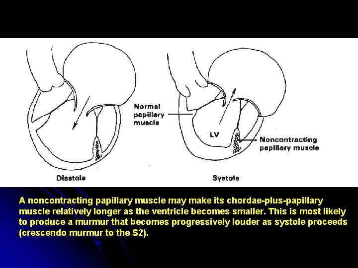 A noncontracting papillary muscle may make its chordae-plus-papillary muscle relatively longer as the ventricle