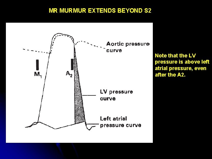 MR MURMUR EXTENDS BEYOND S 2 Note that the LV pressure is above left