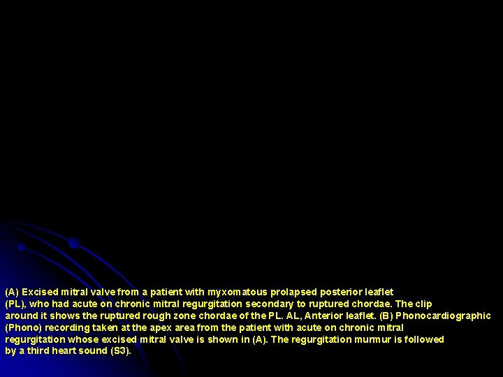 (A) Excised mitral valve from a patient with myxomatous prolapsed posterior leaflet (PL), who