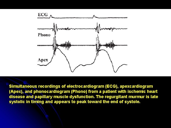 Simultaneous recordings of electrocardiogram (ECG), apexcardiogram (Apex), and phonocardiogram (Phono) from a patient with