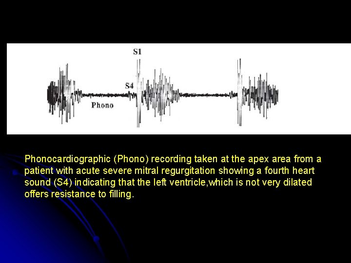 Phonocardiographic (Phono) recording taken at the apex area from a patient with acute severe