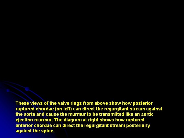 These views of the valve rings from above show posterior ruptured chordae (on left)