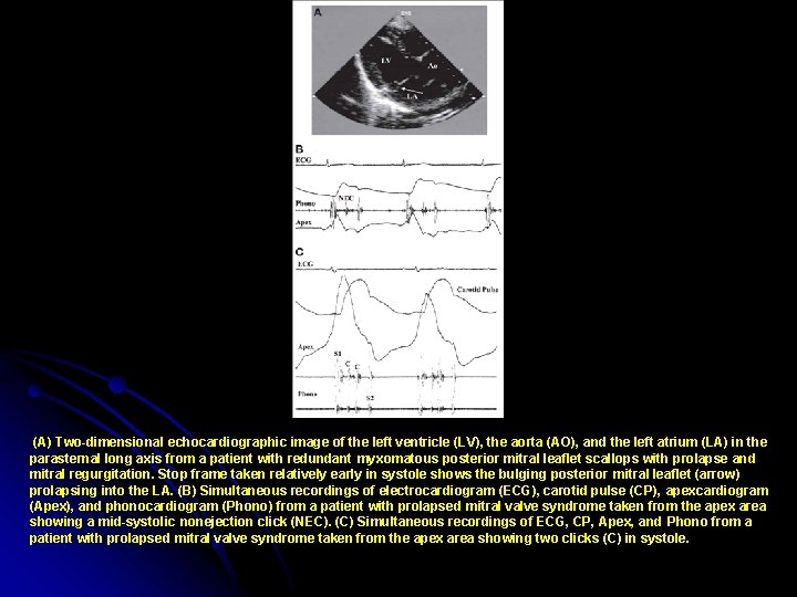 (A) Two-dimensional echocardiographic image of the left ventricle (LV), the aorta (AO), and the
