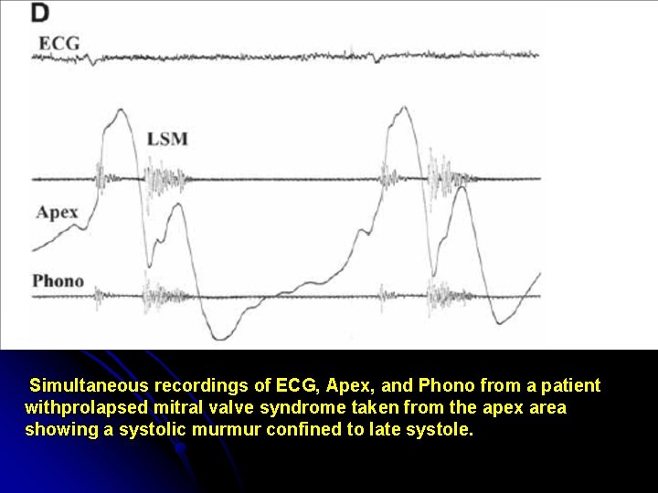 Simultaneous recordings of ECG, Apex, and Phono from a patient withprolapsed mitral valve syndrome