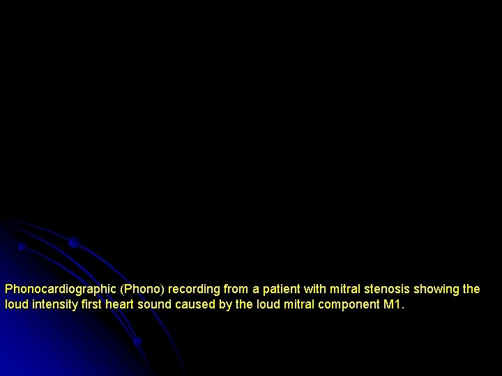 Phonocardiographic (Phono) recording from a patient with mitral stenosis showing the loud intensity first