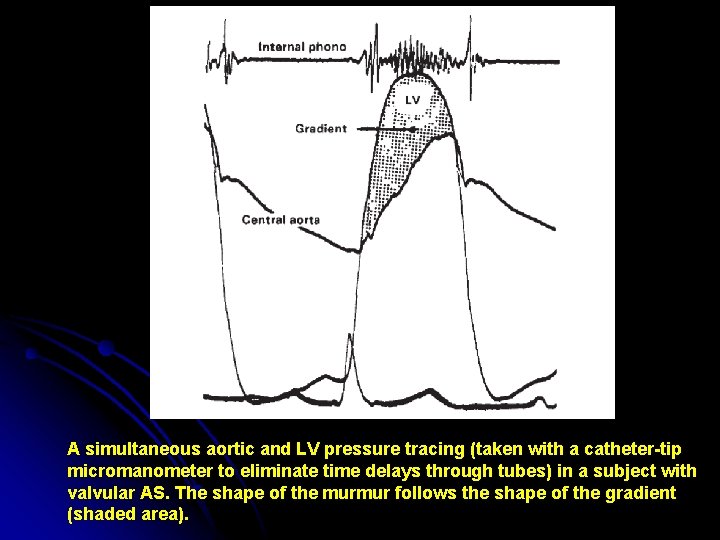 A simultaneous aortic and LV pressure tracing (taken with a catheter-tip micromanometer to eliminate