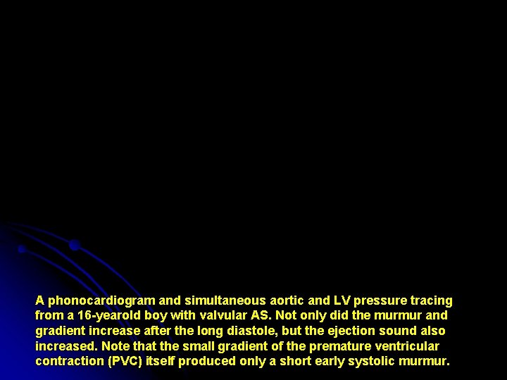 A phonocardiogram and simultaneous aortic and LV pressure tracing from a 16 -yearold boy