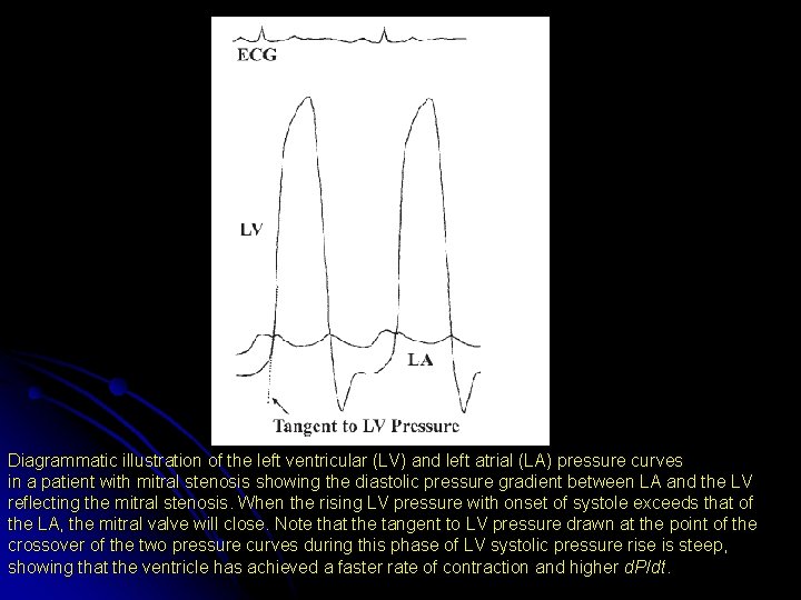 Diagrammatic illustration of the left ventricular (LV) and left atrial (LA) pressure curves in