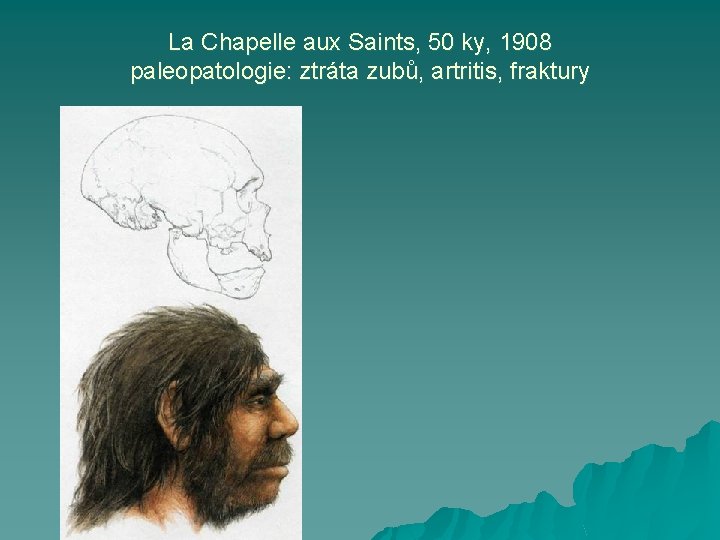 La Chapelle aux Saints, 50 ky, 1908 paleopatologie: ztráta zubů, artritis, fraktury 