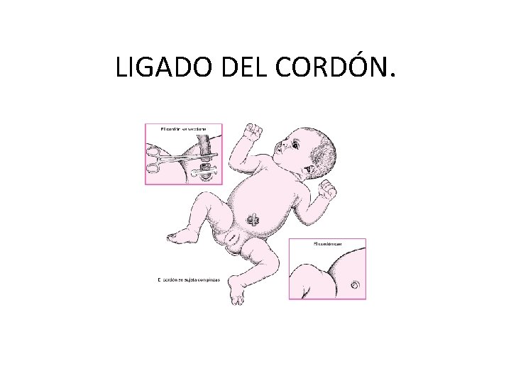 LIGADO DEL CORDÓN. 