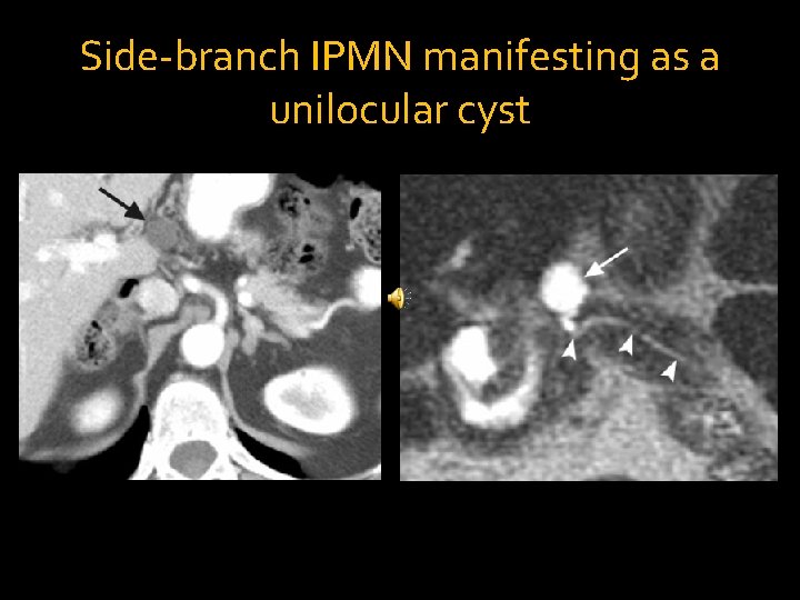 Side-branch IPMN manifesting as a unilocular cyst 