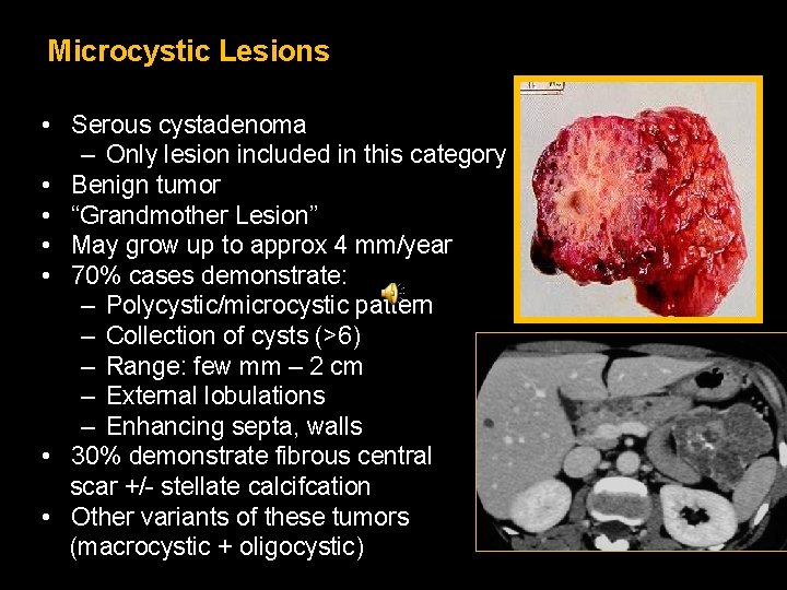 Microcystic Lesions • Serous cystadenoma – Only lesion included in this category • Benign