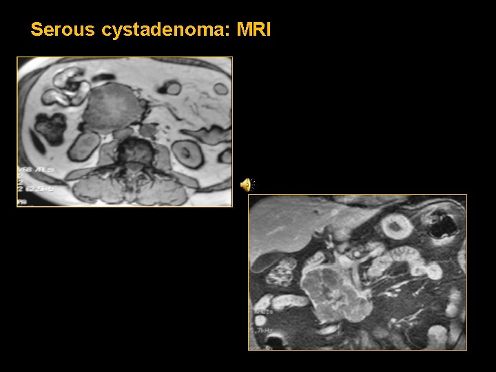 Serous cystadenoma: MRI Serous cystadenoma: MRI