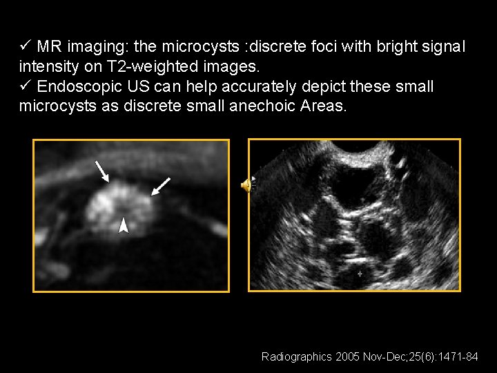 ü MR imaging: the microcysts : discrete foci with bright signal intensity on T