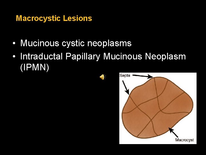 Macrocystic Lesions • Mucinous cystic neoplasms • Intraductal Papillary Mucinous Neoplasm (IPMN) Macrocystic Lesions • Mucinous cystic neoplasms • Intraductal Papillary Mucinous Neoplasm (IPMN)