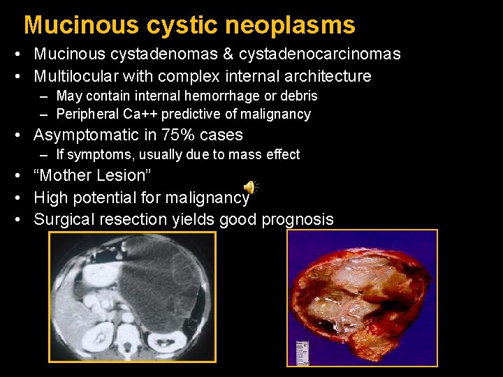 Mucinous cystic neoplasms • Mucinous cystadenomas & cystadenocarcinomas • Multilocular with complex internal architecture