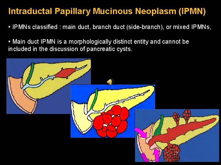 Intraductal Papillary Mucinous Neoplasm (IPMN) • IPMNs classified : main duct, branch duct (side-branch), Intraductal Papillary Mucinous Neoplasm (IPMN) • IPMNs classified : main duct, branch duct (side-branch),