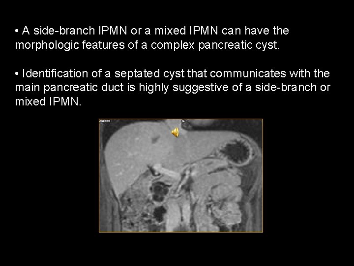  • A side-branch IPMN or a mixed IPMN can have the morphologic features