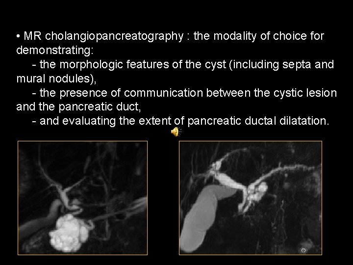  • MR cholangiopancreatography : the modality of choice for demonstrating: - the morphologic