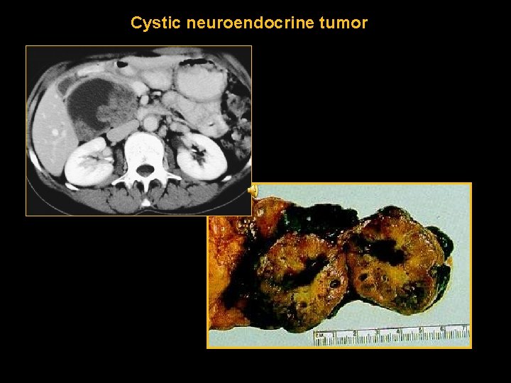 Cystic neuroendocrine tumor 