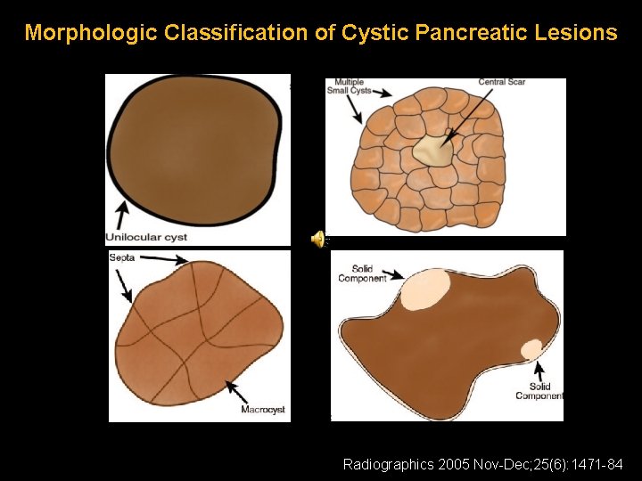 Morphologic Classification of Cystic Pancreatic Lesions Radiographics 2005 Nov-Dec; 25(6): 1471 -84 