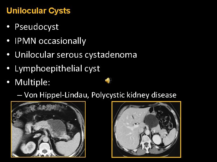 Unilocular Cysts • • • Pseudocyst IPMN occasionally Unilocular serous cystadenoma Lymphoepithelial cyst Multiple: