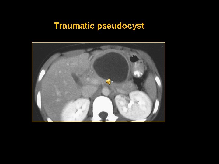 Traumatic pseudocyst 