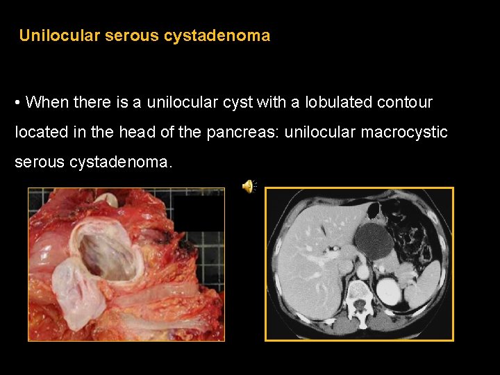 Unilocular serous cystadenoma • When there is a unilocular cyst with a lobulated contour