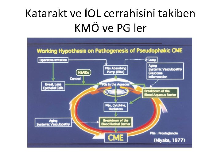 Katarakt ve İOL cerrahisini takiben KMÖ ve PG ler 