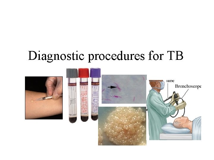 Diagnostic procedures for TB 