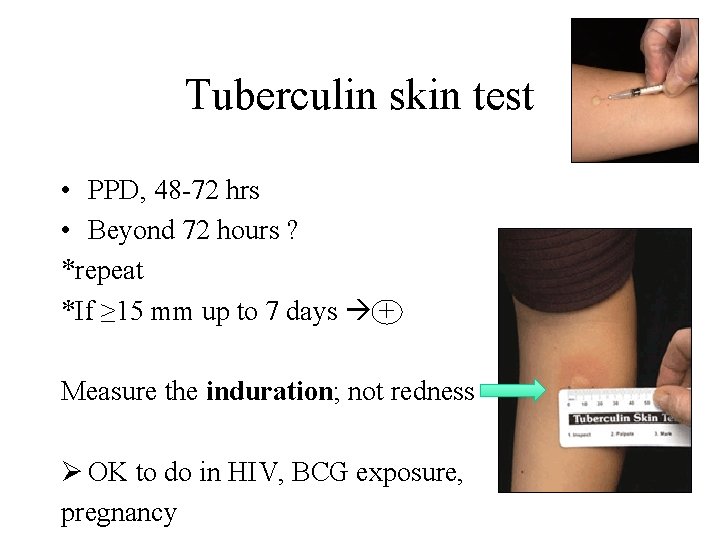 Tuberculin skin test • PPD, 48 -72 hrs • Beyond 72 hours ? *repeat
