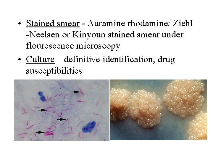  • Stained smear - Auramine rhodamine/ Ziehl -Neelsen or Kinyoun stained smear under