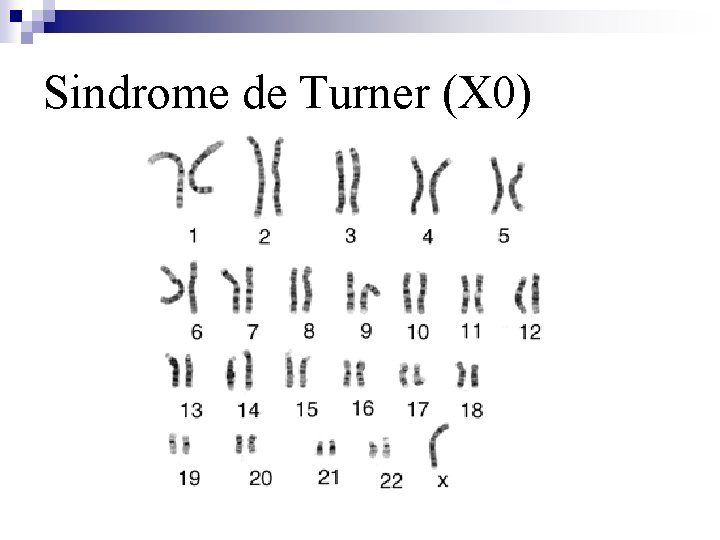 Sindrome de Turner (X 0) 