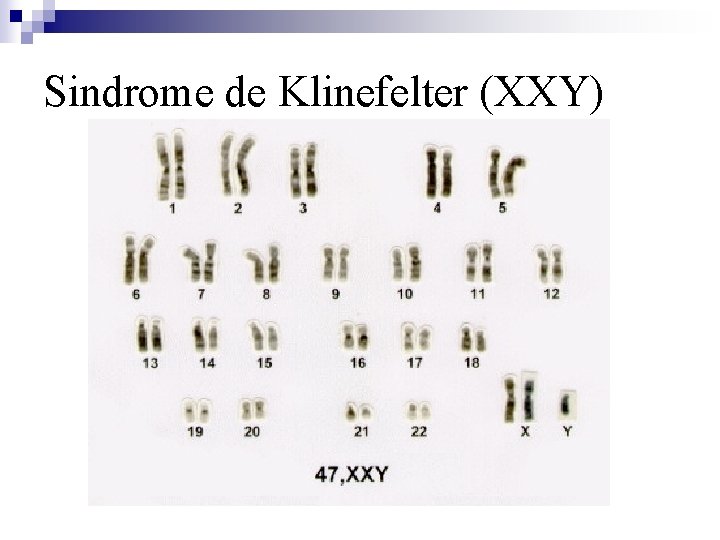 Sindrome de Klinefelter (XXY) 