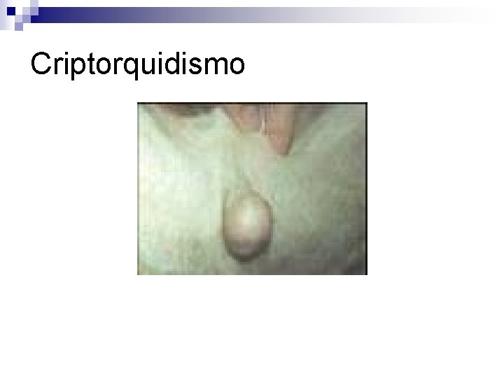 Criptorquidismo 