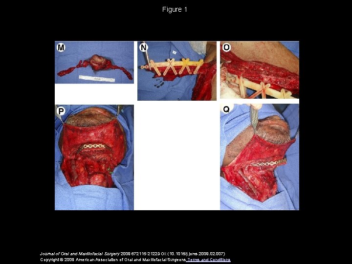 Figure 1 Journal of Oral and Maxillofacial Surgery 2009 672115 -2122 DOI: (10. 1016/j.