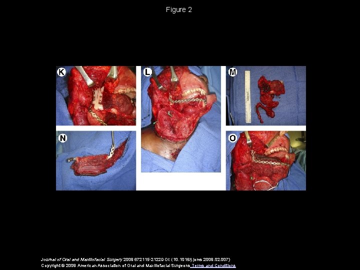 Figure 2 Journal of Oral and Maxillofacial Surgery 2009 672115 -2122 DOI: (10. 1016/j.