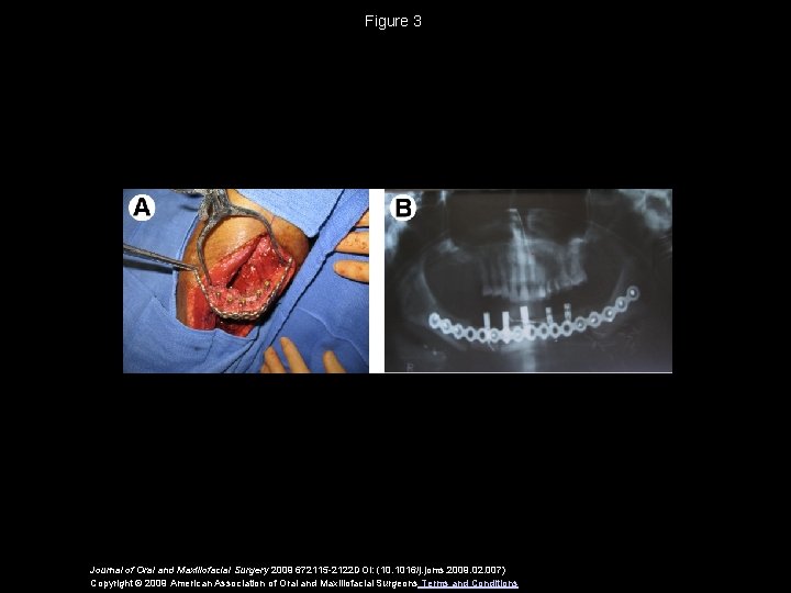 Figure 3 Journal of Oral and Maxillofacial Surgery 2009 672115 -2122 DOI: (10. 1016/j.