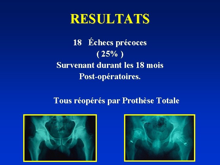 RESULTATS 18 Échecs précoces ( 25% ) Survenant durant les 18 mois Post-opératoires. Tous