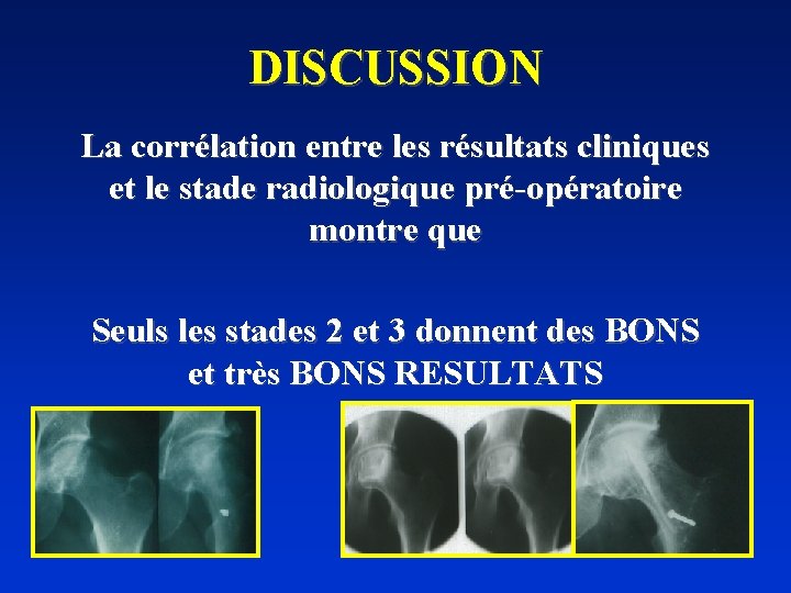 DISCUSSION La corrélation entre les résultats cliniques et le stade radiologique pré-opératoire montre que