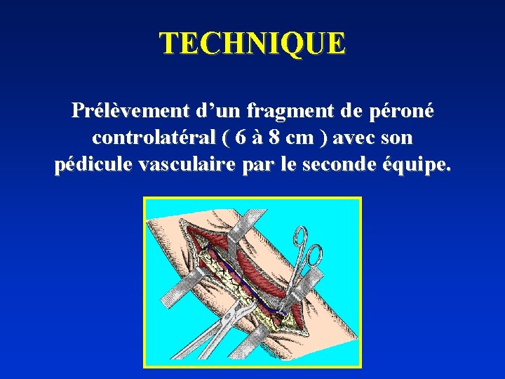 TECHNIQUE Prélèvement d’un fragment de péroné controlatéral ( 6 à 8 cm ) avec