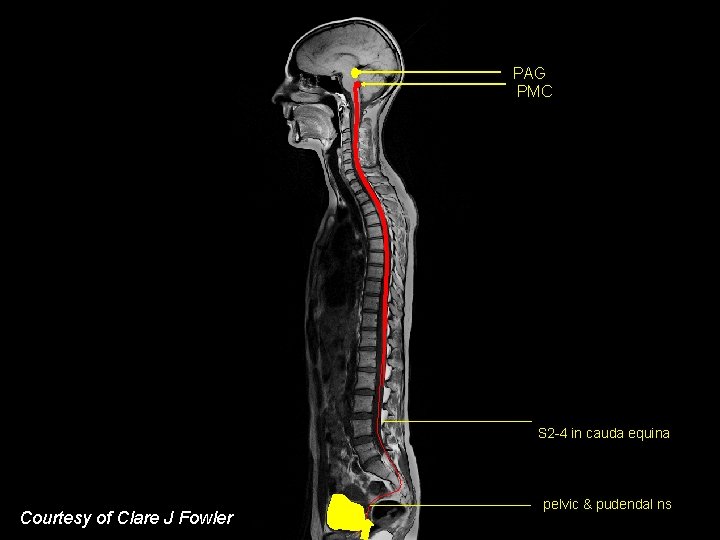 PAG PMC S 2 -4 in cauda equina Courtesy of Clare J Fowler pelvic