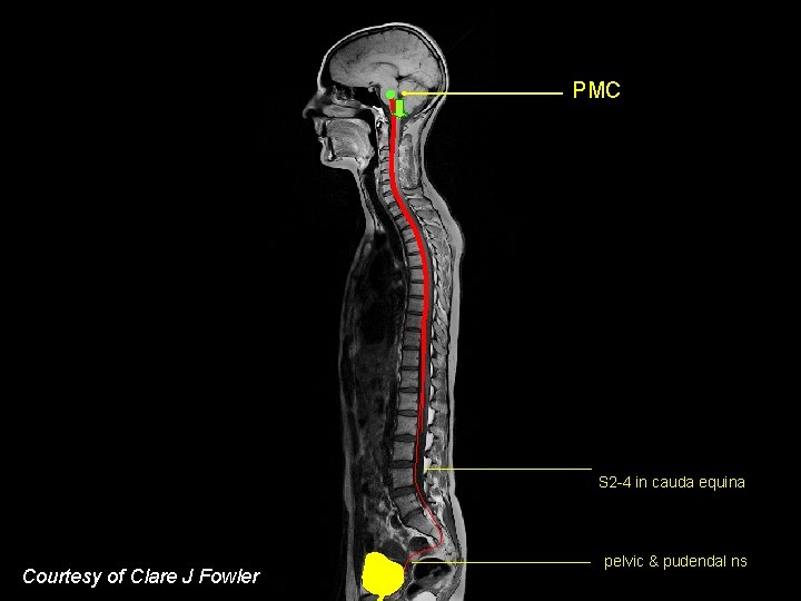PMC S 2 -4 in cauda equina Courtesy of Clare J Fowler pelvic &